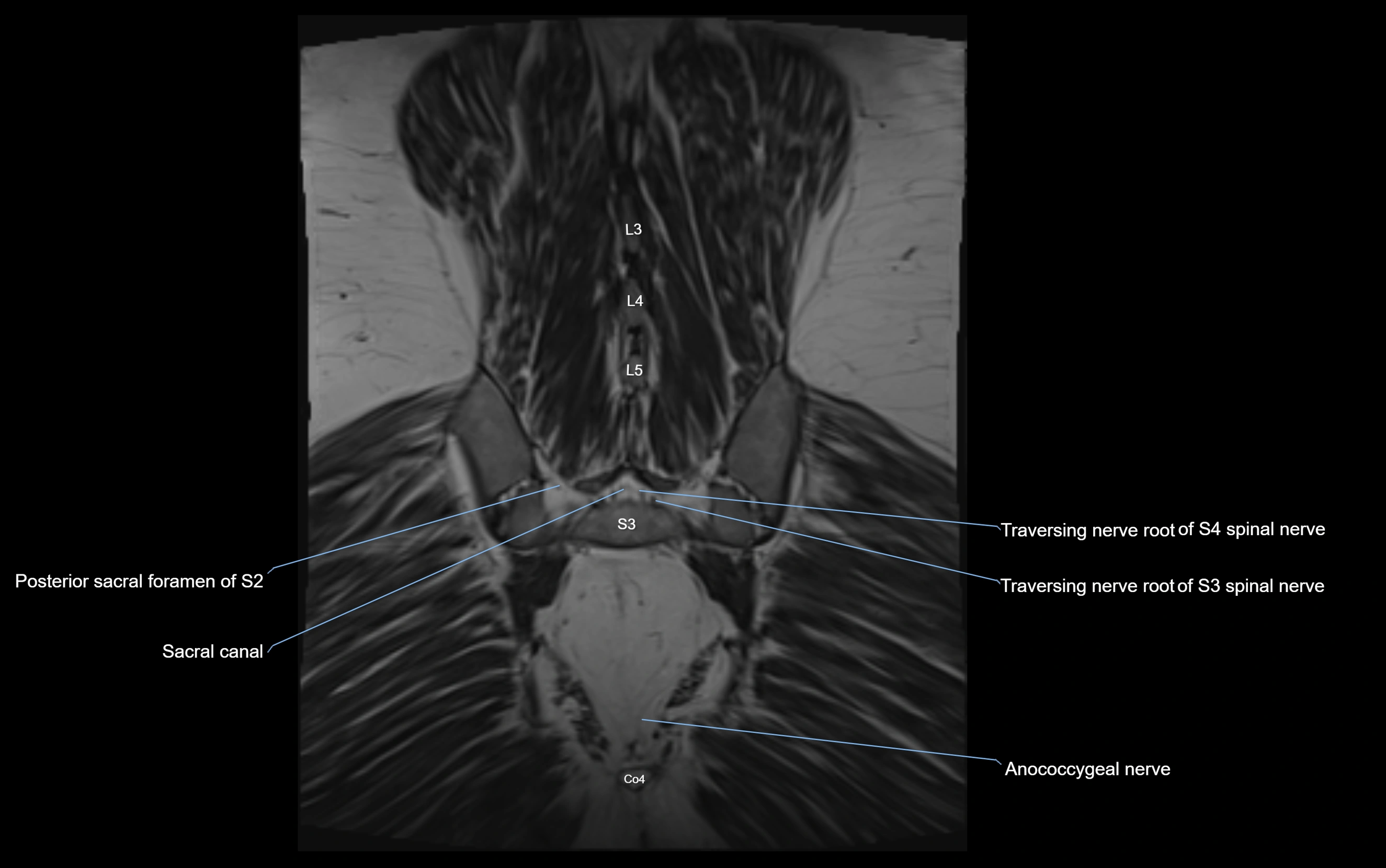 MR lumbosacral plexus cross sectional anatomy 3T  radiology  image-img-09001-00070.webp
